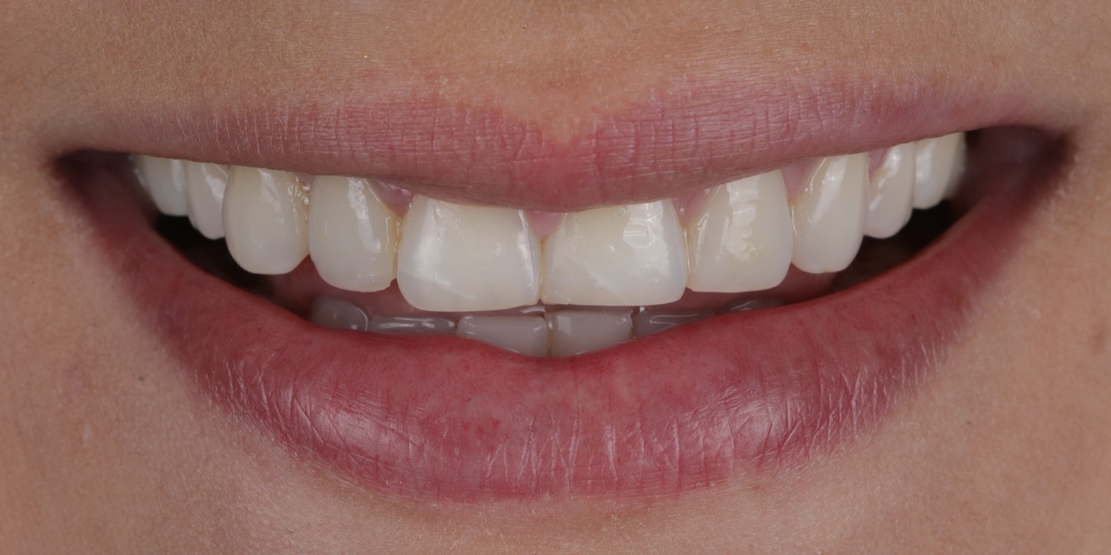 Sonrisa con bordes incisales desgastados e irregulares antes del tratamiento con carillas