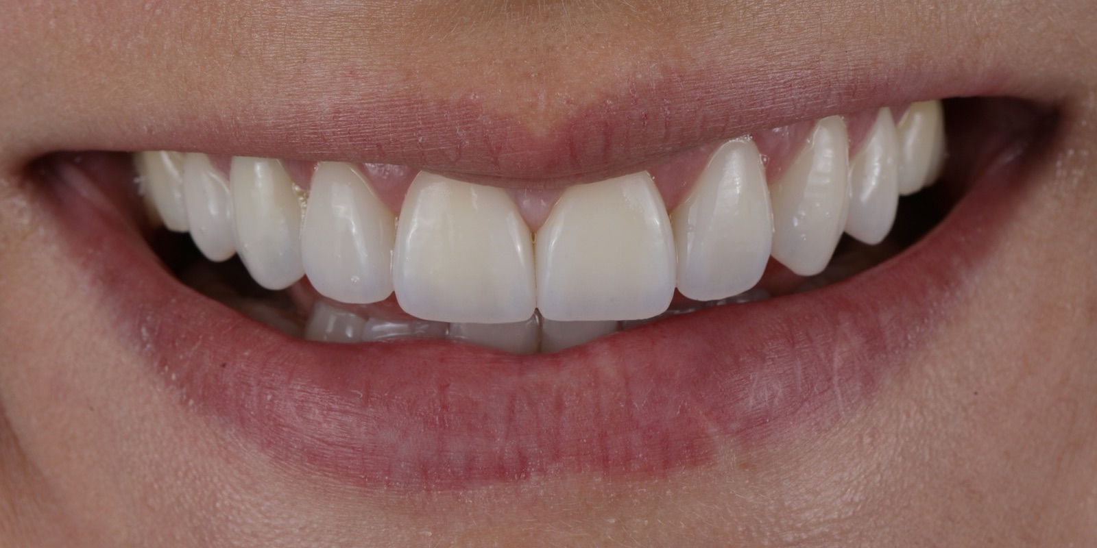 Sonrisa con bordes recuperados y dientes anteriores integrados a los labios después de las carillas