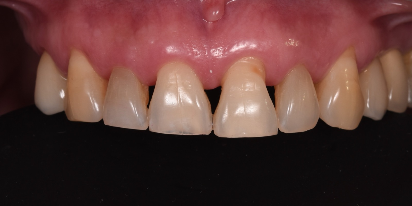 Dientes anteriores superiores con desgaste y restauraciones antiguas antes del tratamiento
