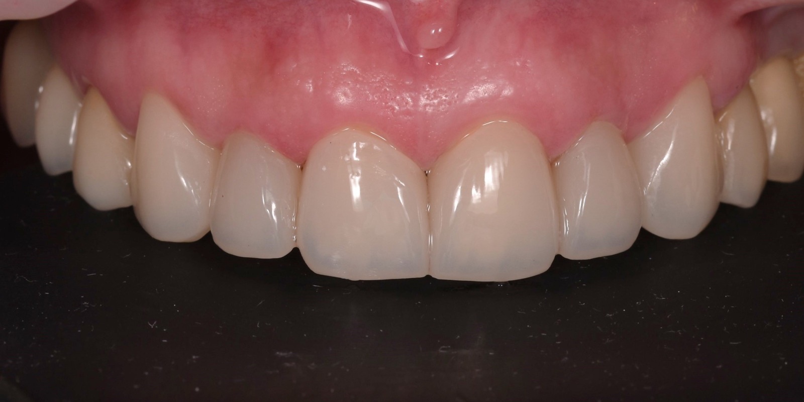Dientes anteriores superiores con anatomía y luminosidad recuperadas después de las carillas