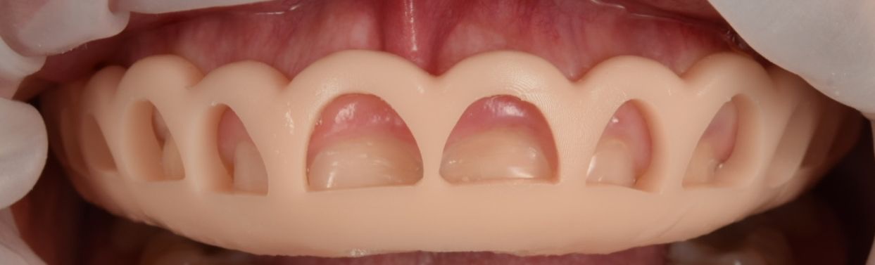 Guía de planificación sobre los dientes que marca el nuevo contorno de la encía