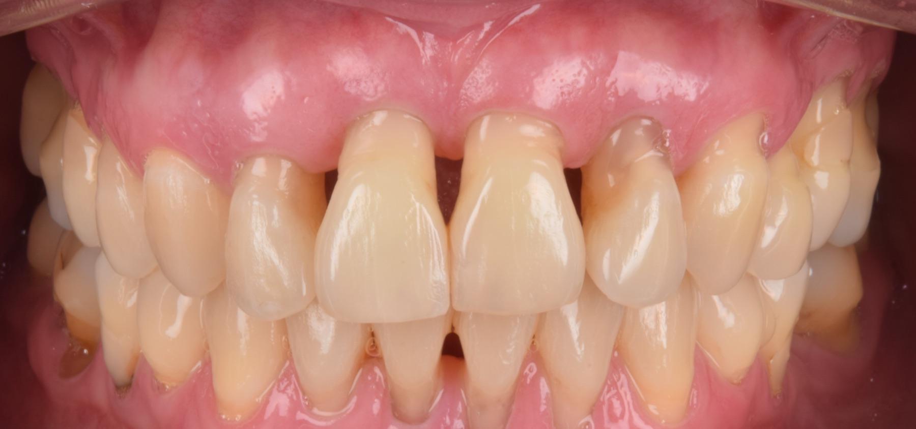 Sonrisa con espacios entre los dientes y retracción de encía, antes del tratamiento interdisciplinario