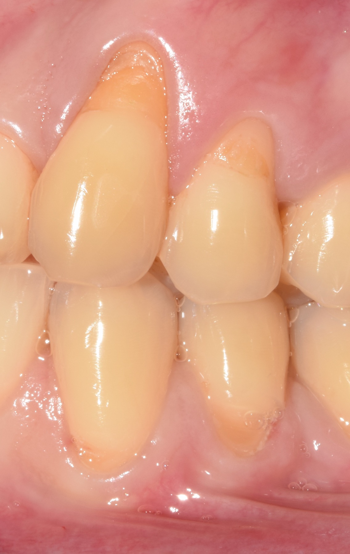 Recesión gingival localizada en premolar superior, antes