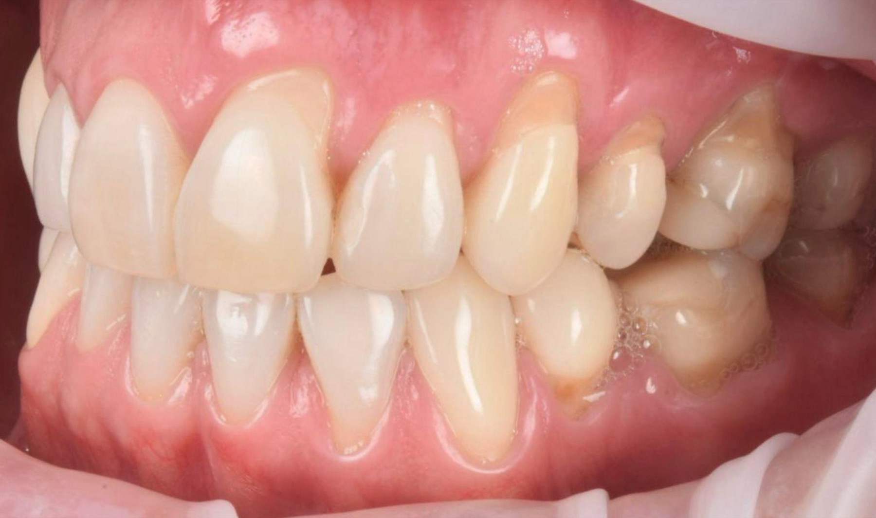 Recesión gingival con raíces expuestas en sector anterior superior, antes de la cirugía