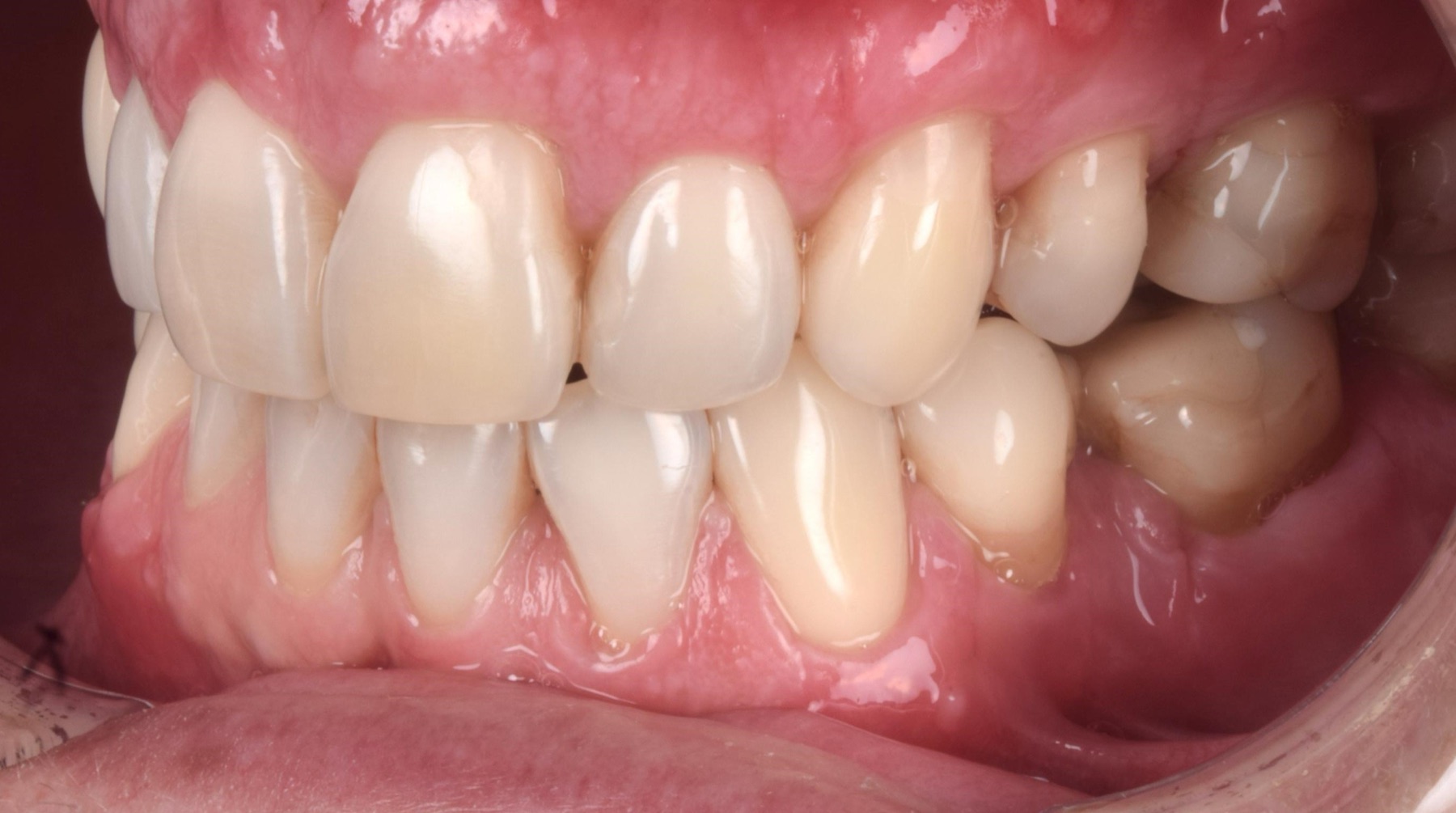 Cobertura radicular lograda, encía integrada al contorno de los dientes